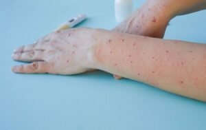 Dinkes DKI Terus Berupaya Tangani Monkeypox